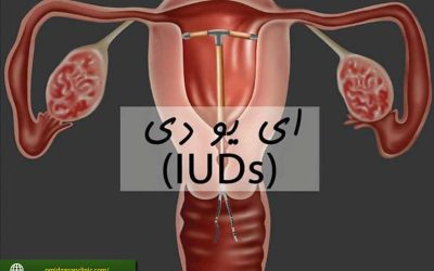 IUDچیست؟