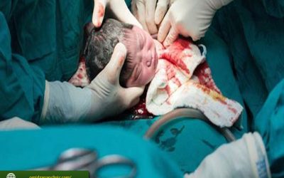 از بین بردن جای بخیه سزارین با پلاسما DBD