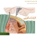 در مورد لاپاراسکوپی بیشتر بدانید